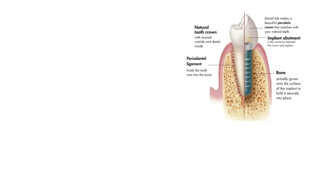 Dental implant treatment in Dombivli at Tulip Dental
