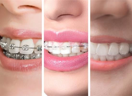 Invisalign clear aligner treatment at Tulip Dental Dombivli