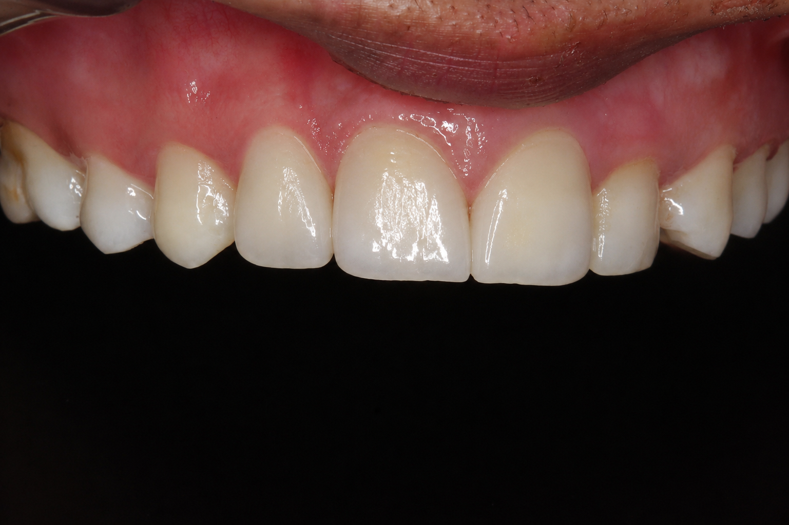 After composite veneers