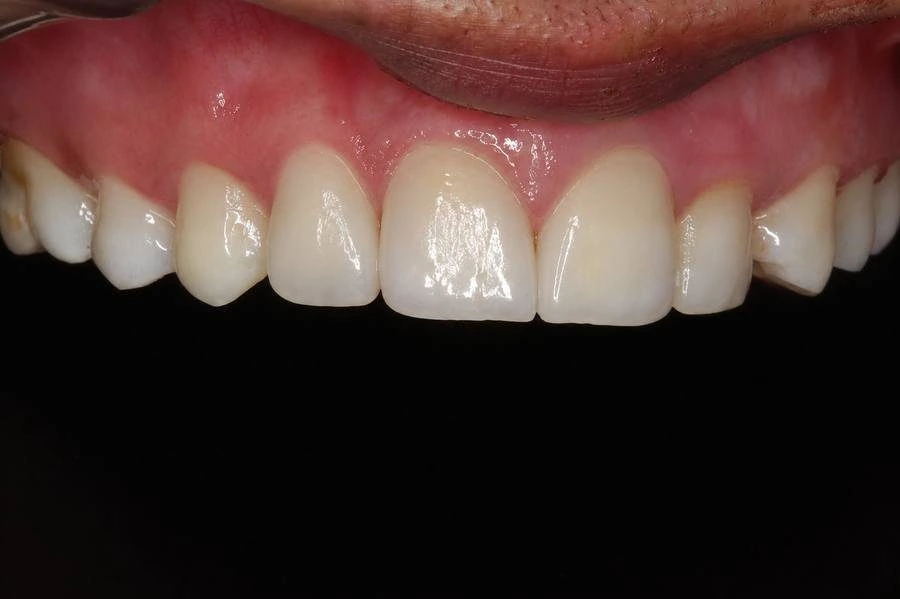 Composite veneers Dombivli