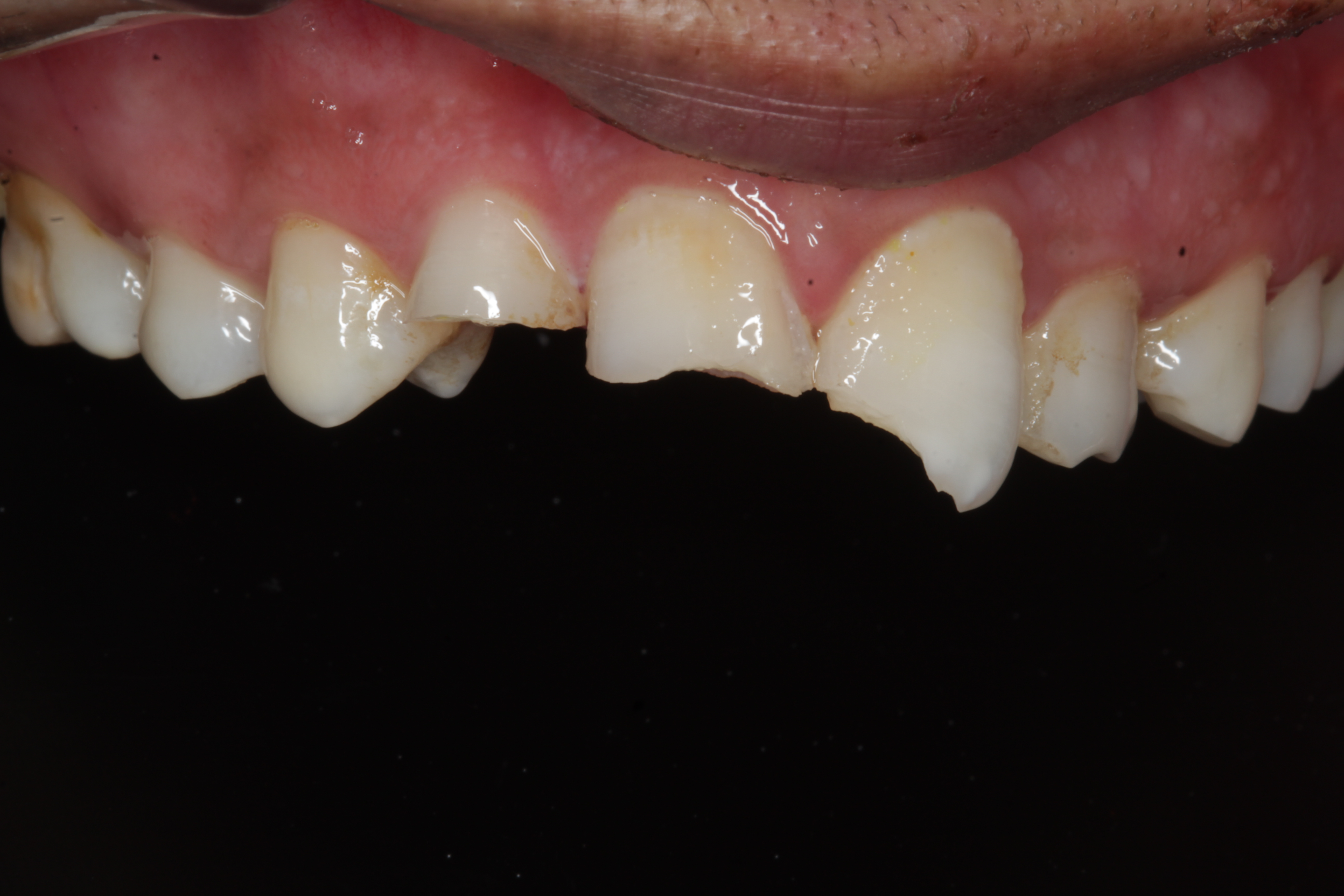 Before composite veneers