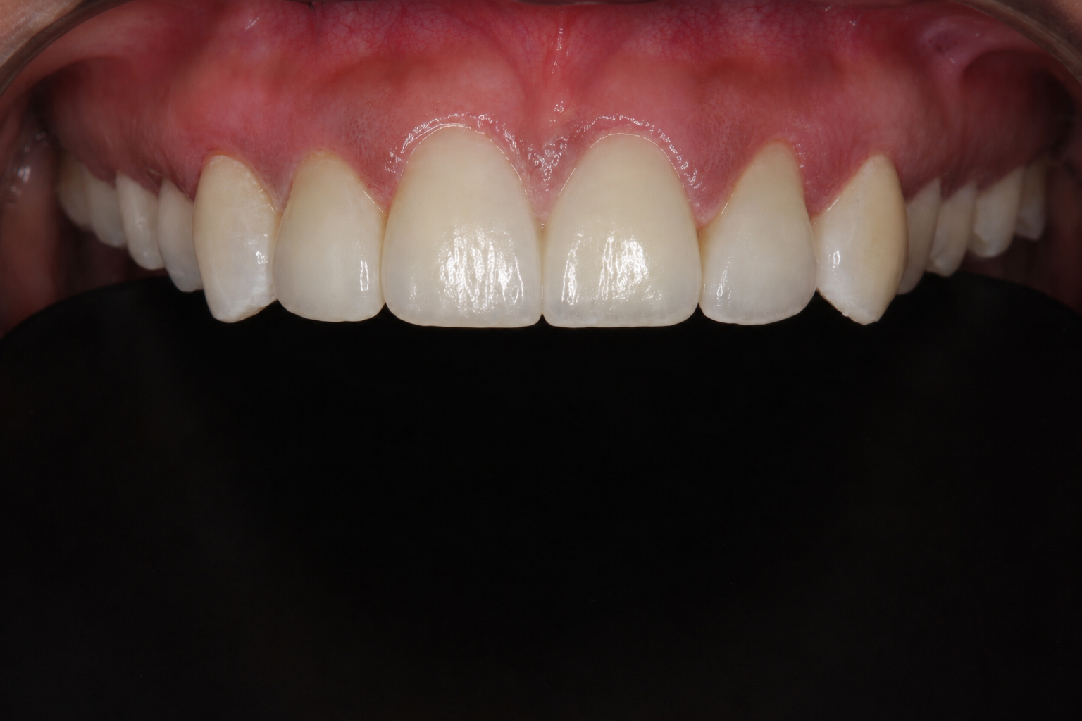 After porcelain veneers