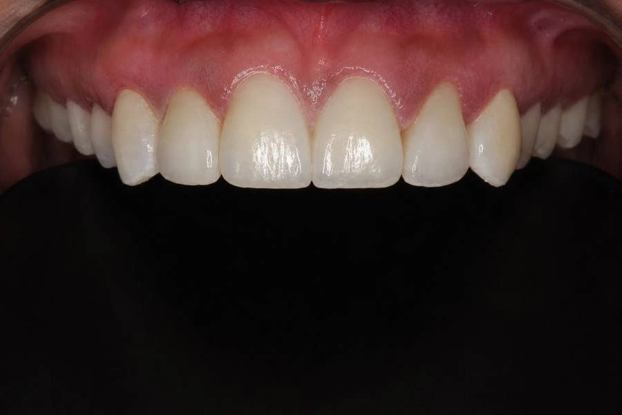 After, Ceramic Veneers Tulip Dental Dombivli