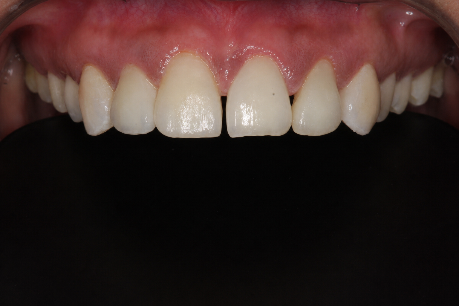 Before porcelain veneers