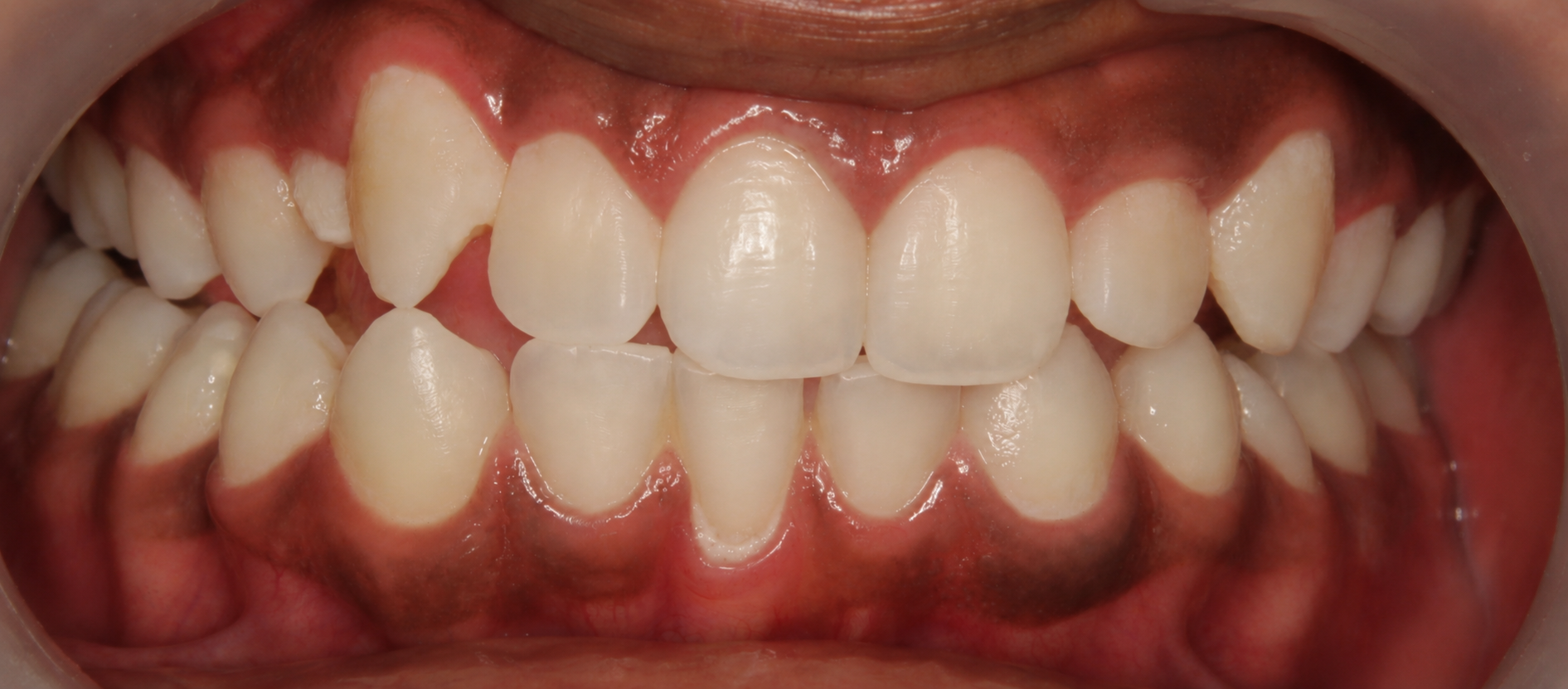 After teeth whitening