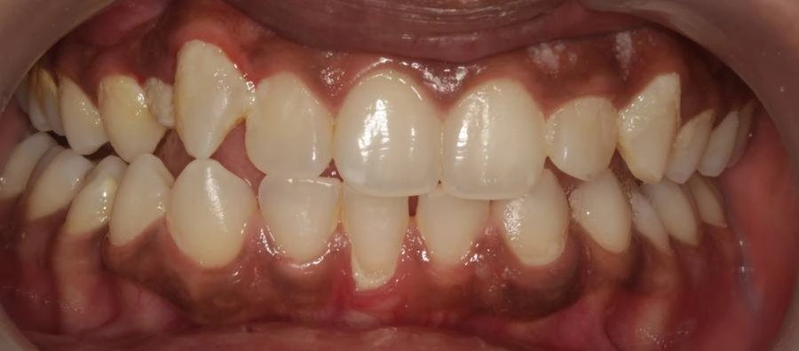 8-Shade Whitening Result — before