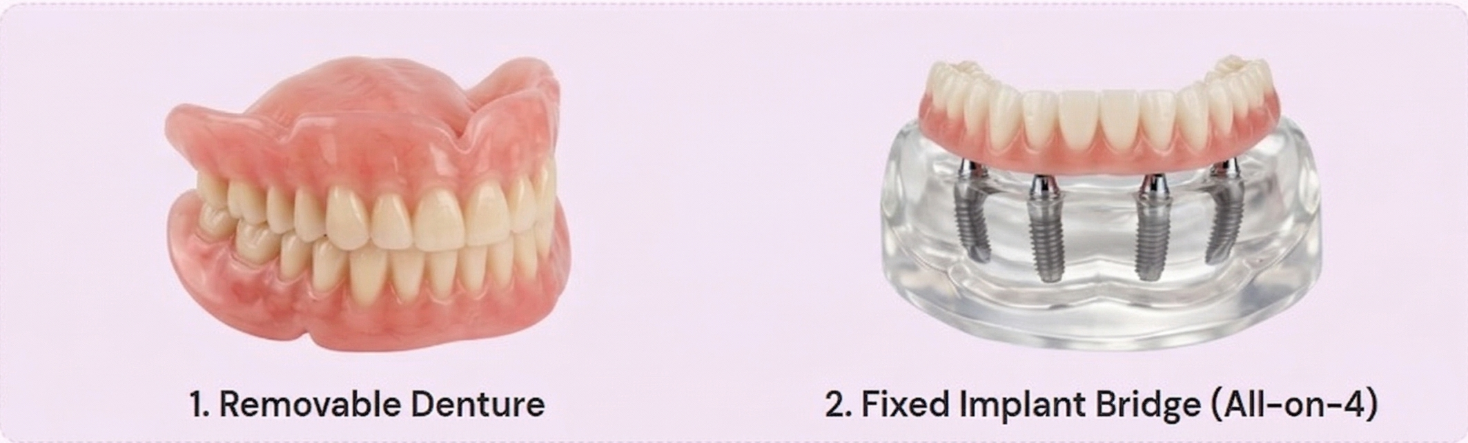 Dentures vs Full Arch Dental Implants — Tulip Dental Dombivli