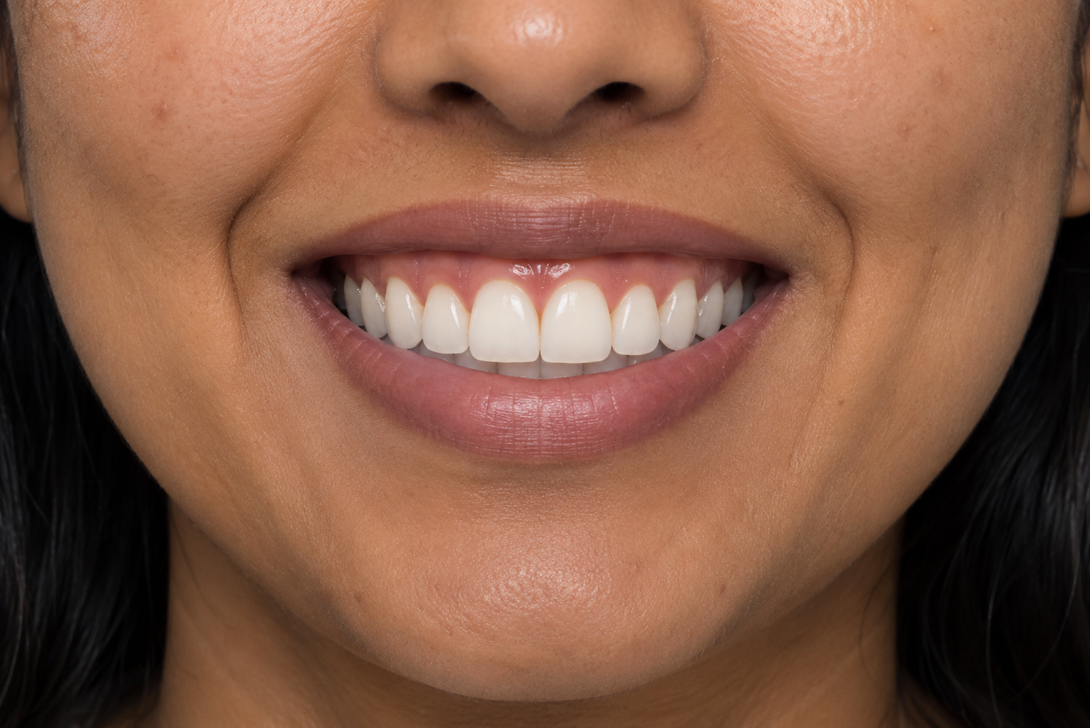 Gum contouring result