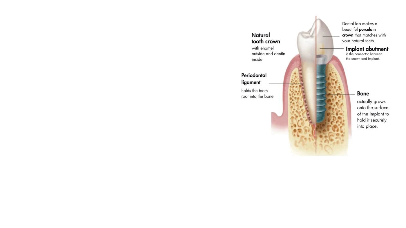 Dental implants Dombivli