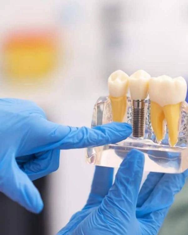 Dental implants Dombivli