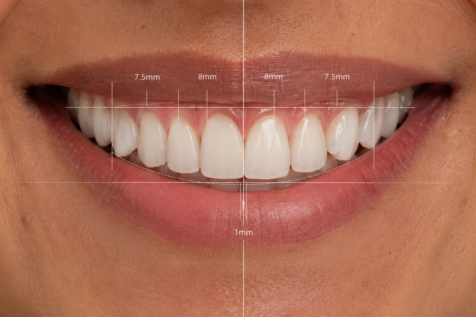 Digital smile design preview