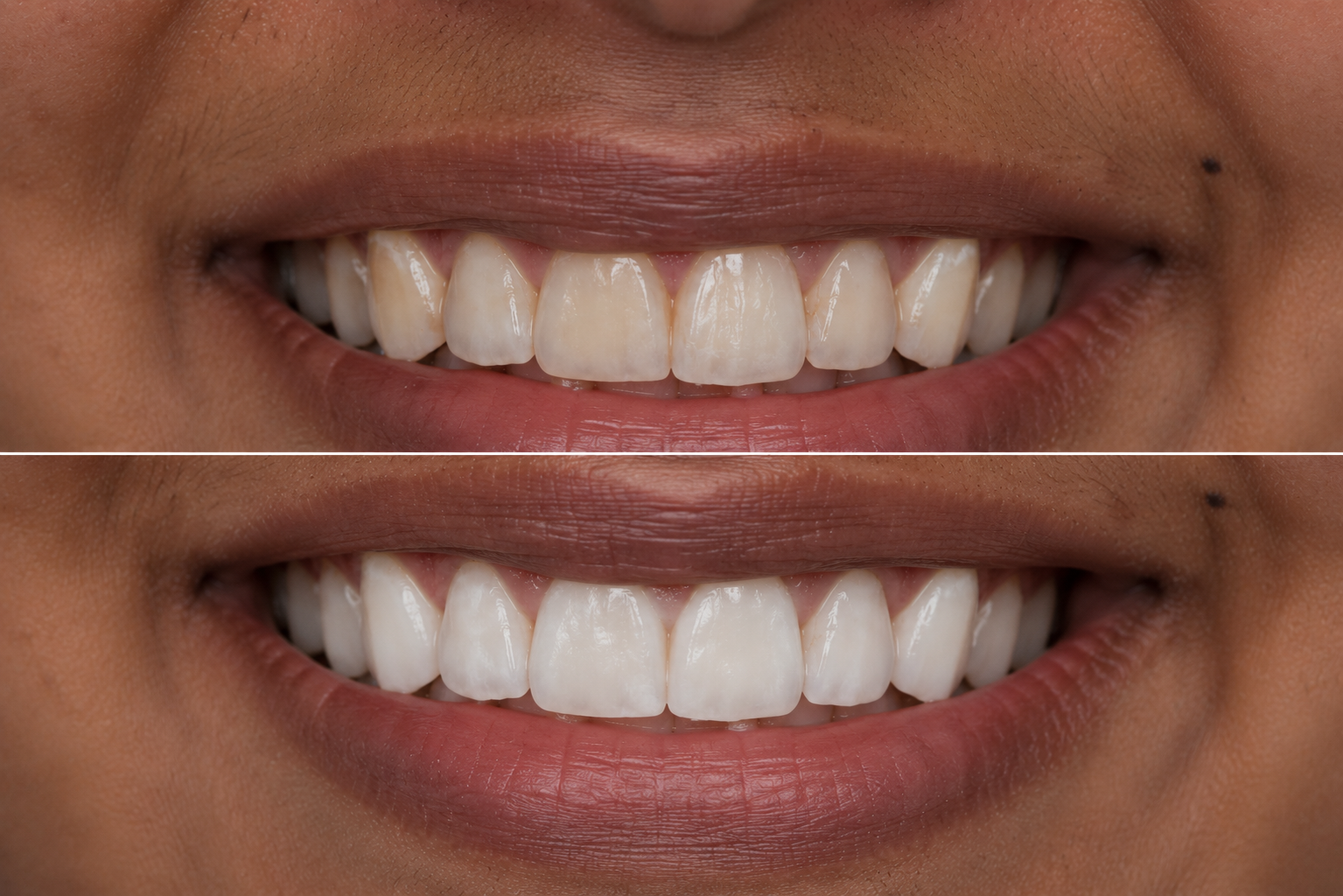 Teeth whitening result